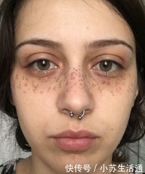 手术@英女子痴迷梅根“雀斑妆”,拙劣手术让面部毁容,花3万治疗修复