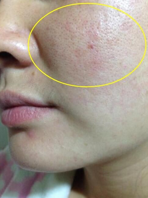 毛孔粗到成小洞，随手一扣都是白色小颗粒，说明内部暗藏过亿螨虫