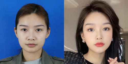  #术后恢复#为什么说春季是医美旺季？最适合整形项目大盘点，必看！
