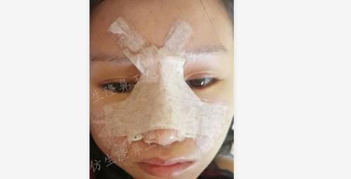  术后■鼻头肥大、山根低、没鼻梁，肋软骨隆鼻后变化有多大？