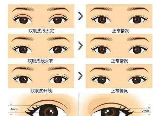  误区|双眼皮手术的几个误区：做不好可以改、宽一点比较有混血感？