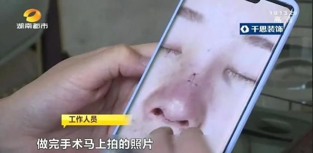  术后：女子花6.5万元隆鼻，术后鼻梁明显偏移，三个月仍未恢复，机构回复：可能是你自己碰的……