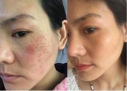 红糖加上它，美白祛斑，坚持两周效果好到爆