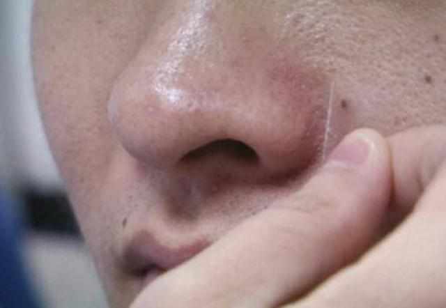 不管男女生，脸上出现3迹象，说明被螨虫缠上，3招把螨虫一窝端