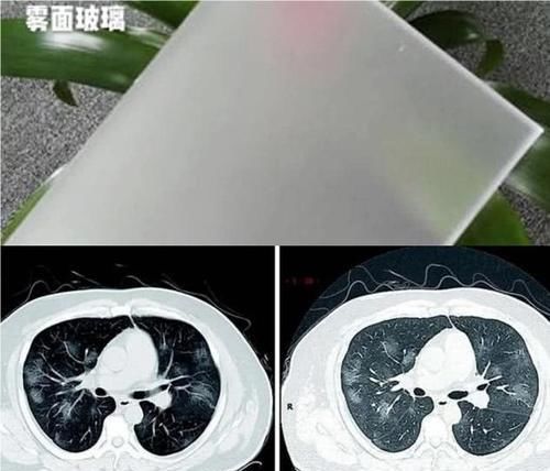 『 病人』于是有人说测体温没意义！医生辟谣，有些新型肺炎病人早期不发热