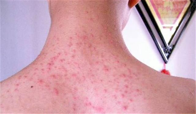 后背螨虫超级多？只要1勺盐，不到一毛钱，螨虫全部死光光！