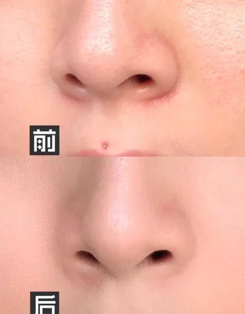  『好变』别再盲目“刷酸”了，刷好了皮肤像剥壳的鸡蛋，没刷好变敏感肌