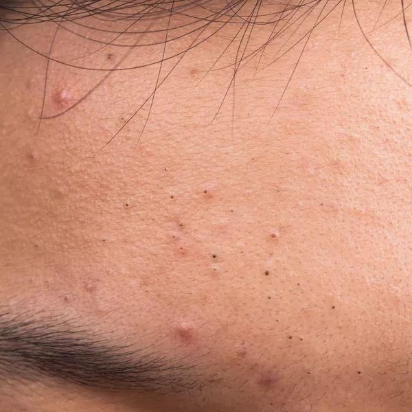 顽固黑头，一招去除，嫩白效果比美颜相机还好!