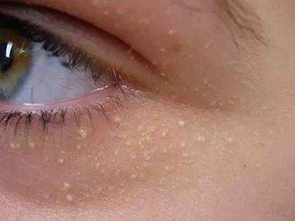 抿嘴后下巴的白色小疙瘩，医生毫不掩饰：是感染了螨虫