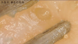 鼻子上为什么会有黑头？本文黑头图片高能警报，没做好准备勿看！