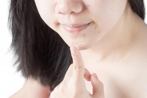  『痘印』痘印怎么才能去掉 这三个办法学会了吗