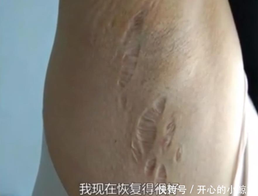 『 激素』疑似慢性谋杀，女子在网上发帖称感冒后被新婚丈夫注射大量激素