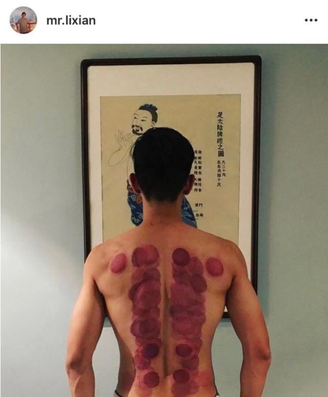  [身体]李现晒拔火罐刮痧后背照，粉丝看完直呼心疼，已经红的发紫