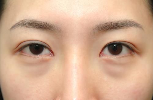 外婆使用家中“一宝”擦脸,三天后眼袋消失,祛眼袋原来这么简单