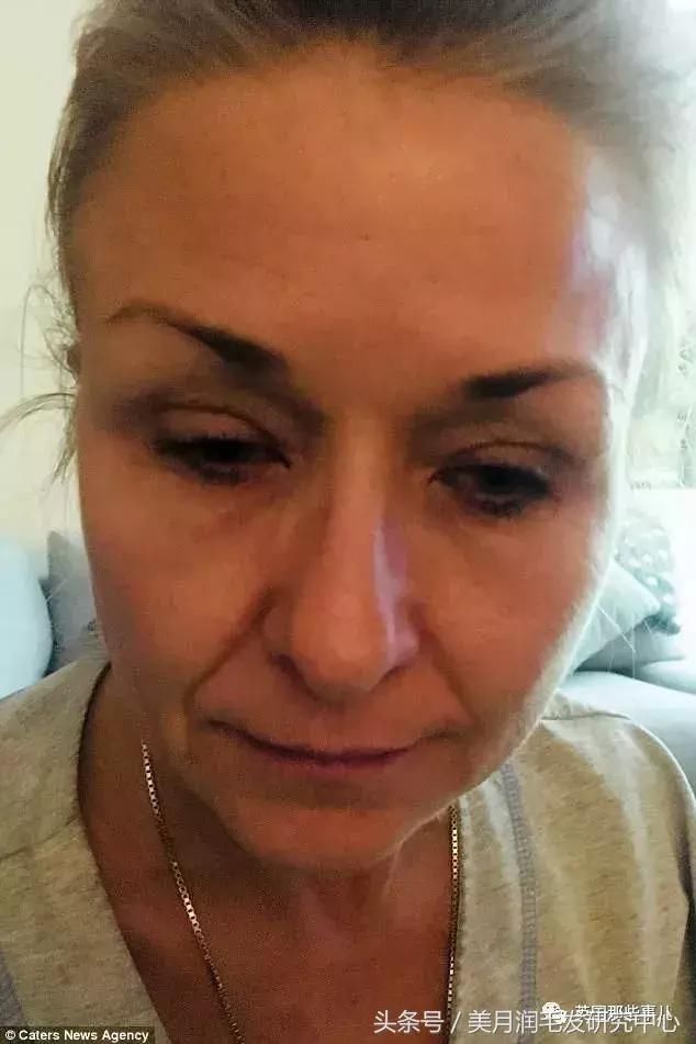 25年不卸妆！女子眼里长结石险失明