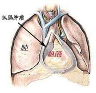  「男子」49岁男子，半年前体检正常，半年后查出肺癌离世体检有用吗