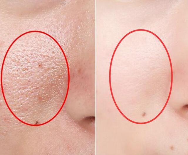 女人有螨虫脸部坑坑洼洼，药店2块钱一包中药粉，去螨虫提亮肤色