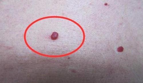 身上长小血痣别大意!可能是肝脏有毒素,4种养