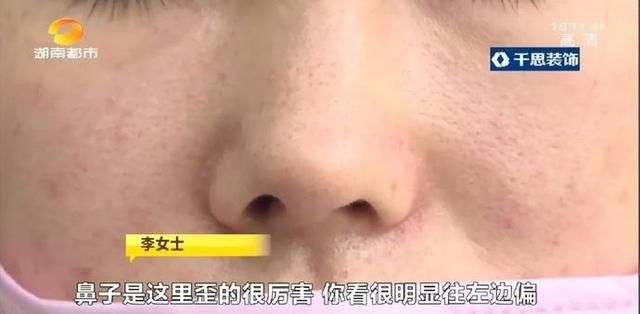  术后：女子花6.5万元隆鼻，术后鼻梁明显偏移，三个月仍未恢复，机构回复：可能是你自己碰的……