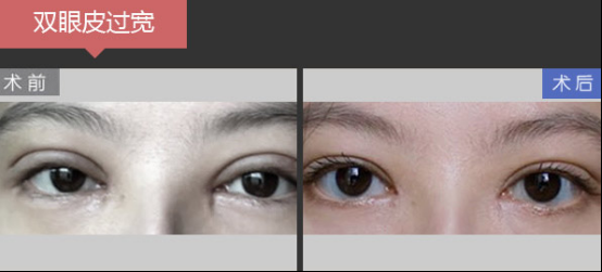 深圳美莱梁志为眼修复案例,她们实现惊艳蜕变