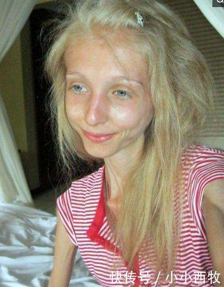 少女因害怕身体走形，每天坚持只喝水不吃食物，如今成“活骷髅”