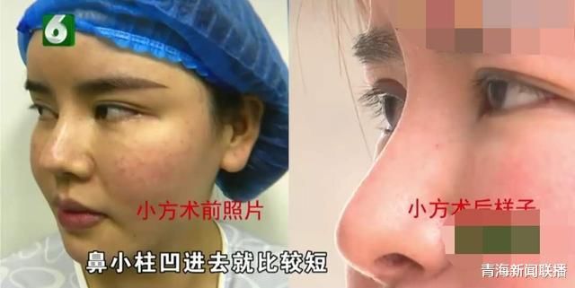  整形效果|女子花4万5做鼻子微整，做完后看到自己就很烦：我不是来毁容的
