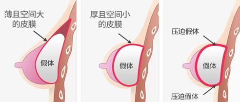  #手术#求美者对于假体隆胸手术切口该如何选择呢？