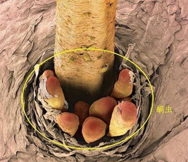 螨虫“打洞做窝”，毛孔粗成一个个洞，再不排螨，毛孔大大大