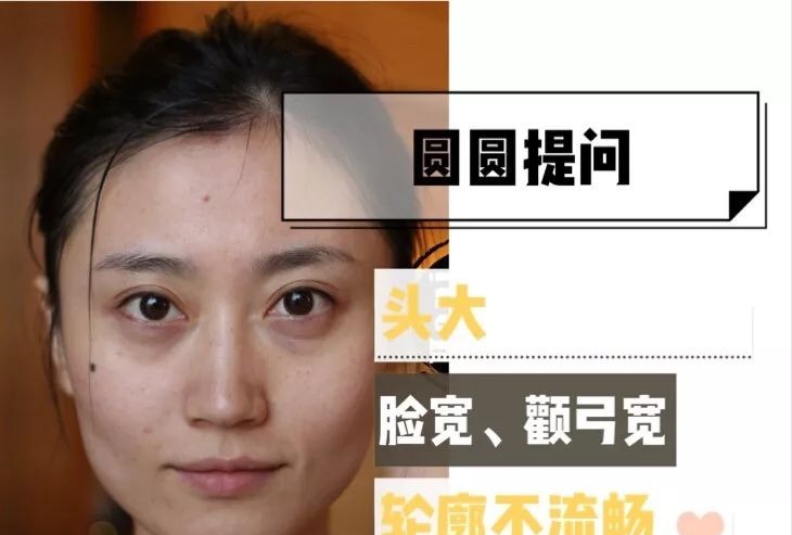 「衰老问题」素人整形分析 | 做对这些,宽方脸比瓜子脸更有优势