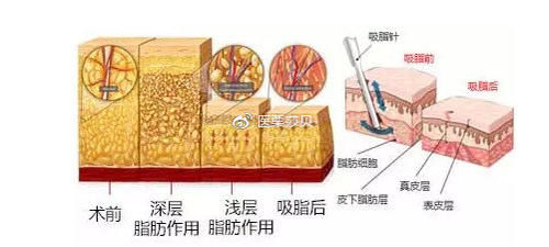 『吸脂』腰腹吸脂皮肤会松弛吗