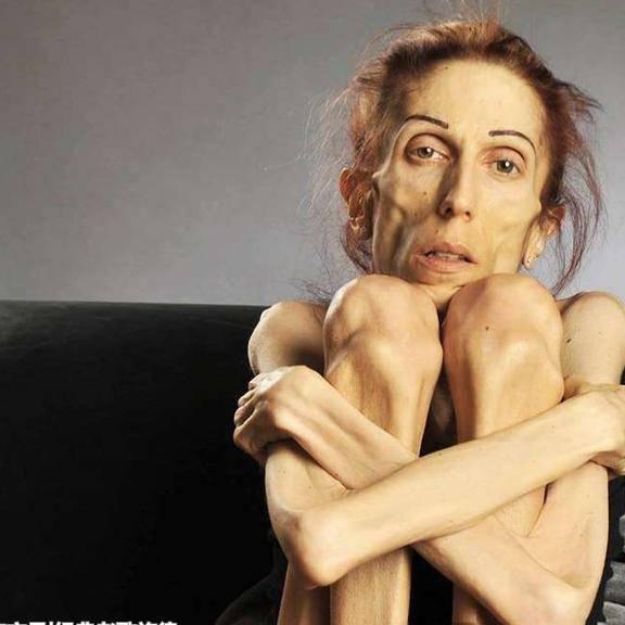 国外一女子从120斤瘦到了30斤,真的是瘦成了一道闪电