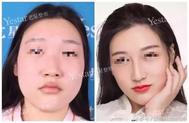 实锤：国民闺女，整容了？