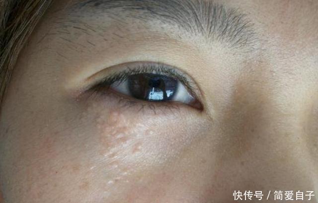  清洁■眼睛下面黄色颗粒，是皮肤清洁不到位？常长脂肪粒其实另有原因！