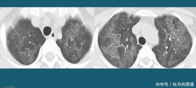 养宠物也得看体质,这个28岁小伙不能养狗,肺过