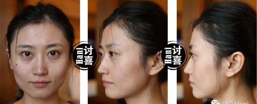 「衰老问题」素人整形分析 | 做对这些,宽方脸比瓜子脸更有优势