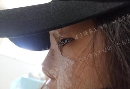  术后■鼻头肥大、山根低、没鼻梁，肋软骨隆鼻后变化有多大？