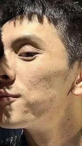  「没辙」无美颜的李佳琦皮肤这么差，博主都翻车的痘痘问题真没辙了吗？