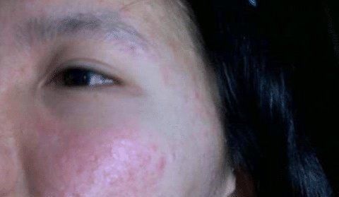 【刺痛】护肤和毁容中间就差一瓶磨砂膏?女孩护肤不成,反被白癜风爬上脸