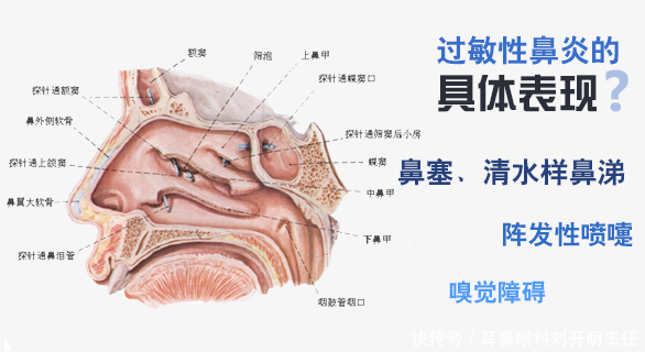 过敏性鼻炎的最佳治疗方法是什么