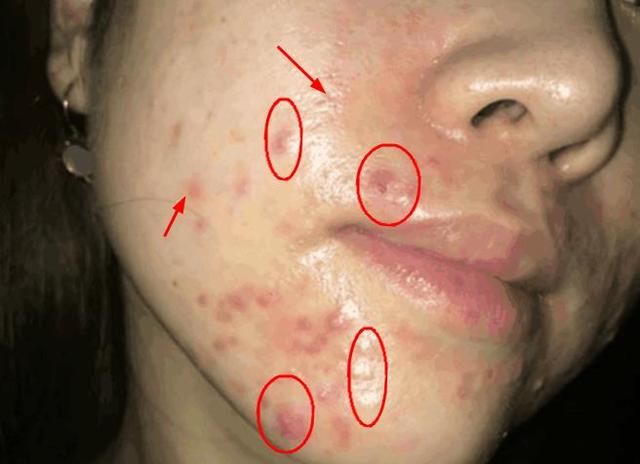 脸上螨虫成灾怎么办?用这一招，螨虫全都死光光