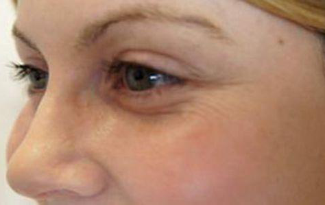 鱼尾纹是怎么形成的 教你去除皱纹呵护眼部肌肤