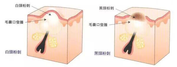市面上那么多去黑头的产品，快来看看你用的是哪类？
