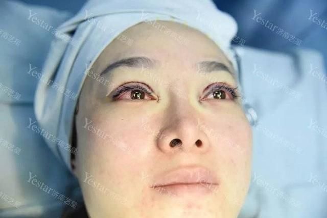  济南■「济南艺星双眼皮」别傻了！这种“无痕双眼皮”其实就是……