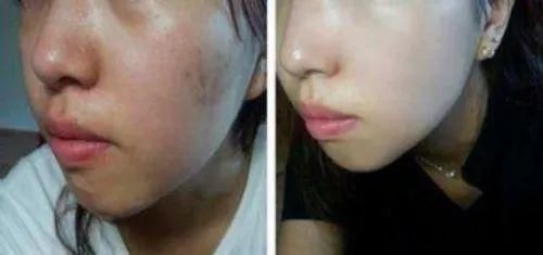 整容遭报应?她的少女脸这么快就烂了?