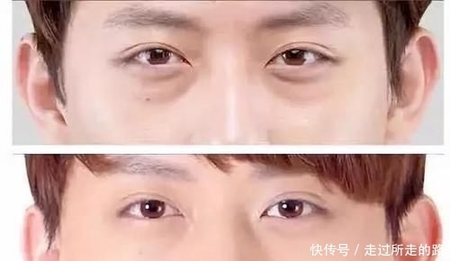 马蹄莲藕@眼袋太大,颜值被拉低!只需这样做,和眼袋说“拜拜”