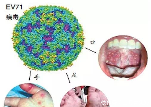 幼儿手足口病及疱疹性咽峡炎进入高发期,请家