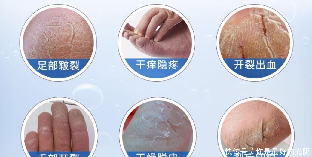 『足底』足底干燥开裂疼痛难忍,用脚裂膏,预防/修护手足开裂!