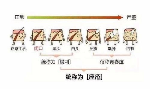  「酸类产品」5大外因导致闭口形成，2大思路解决闭口问题，让你闭口无忧