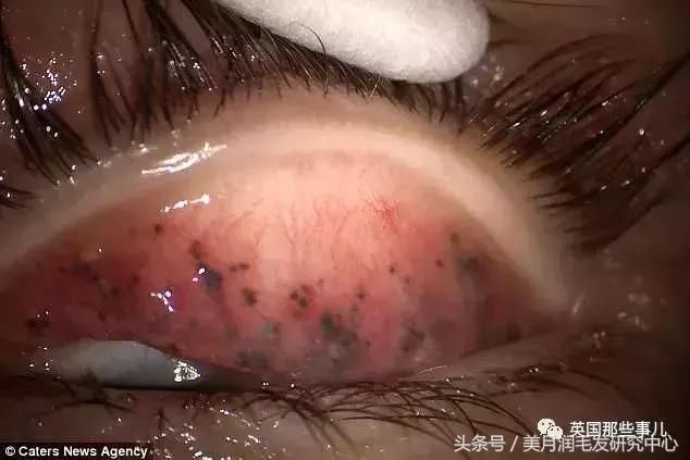 25年不卸妆!女子眼里长结石险失明