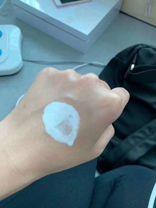  预防：脸上的斑点是如何形成的？看看这4种你有没有，最后一种可预防